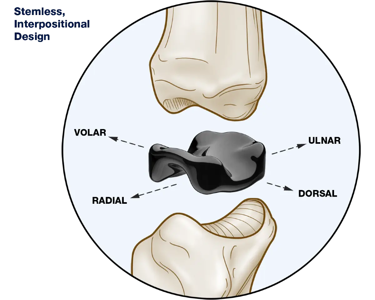 Interpositional design rationale