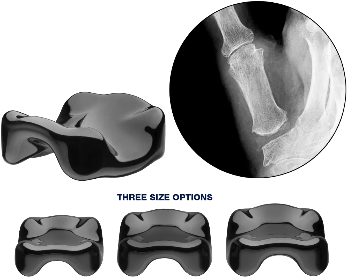 Ensemble CMC implant sizes