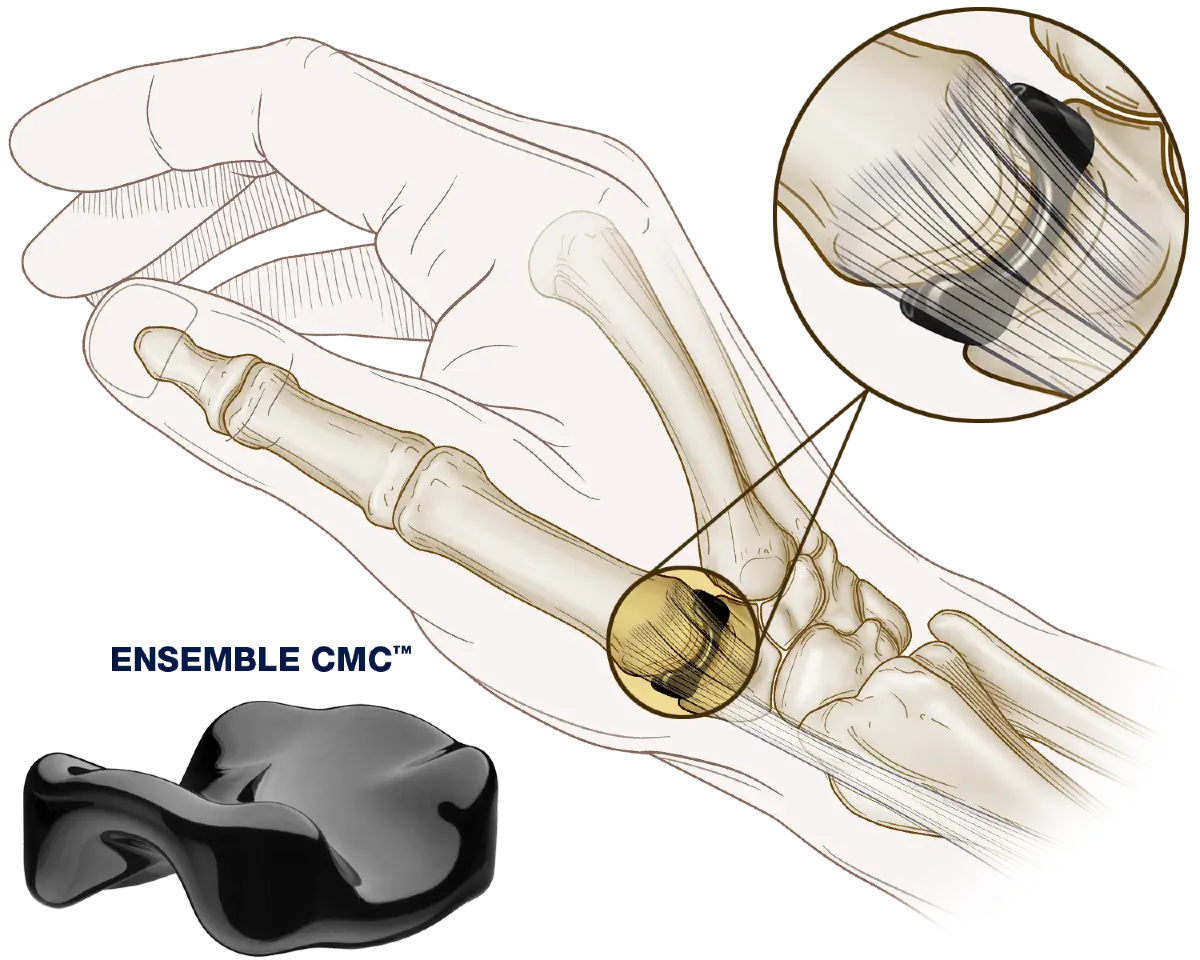 Ensemble CMC implant in hand