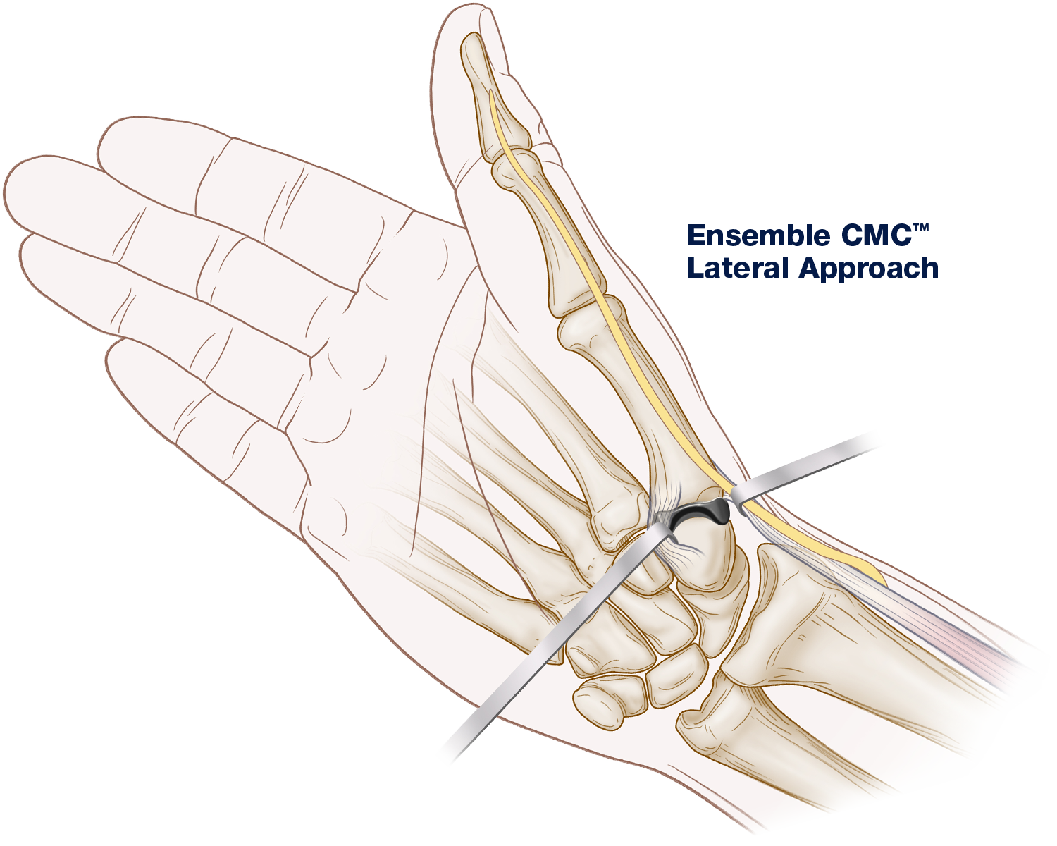 Ensemble CMC lateral approach