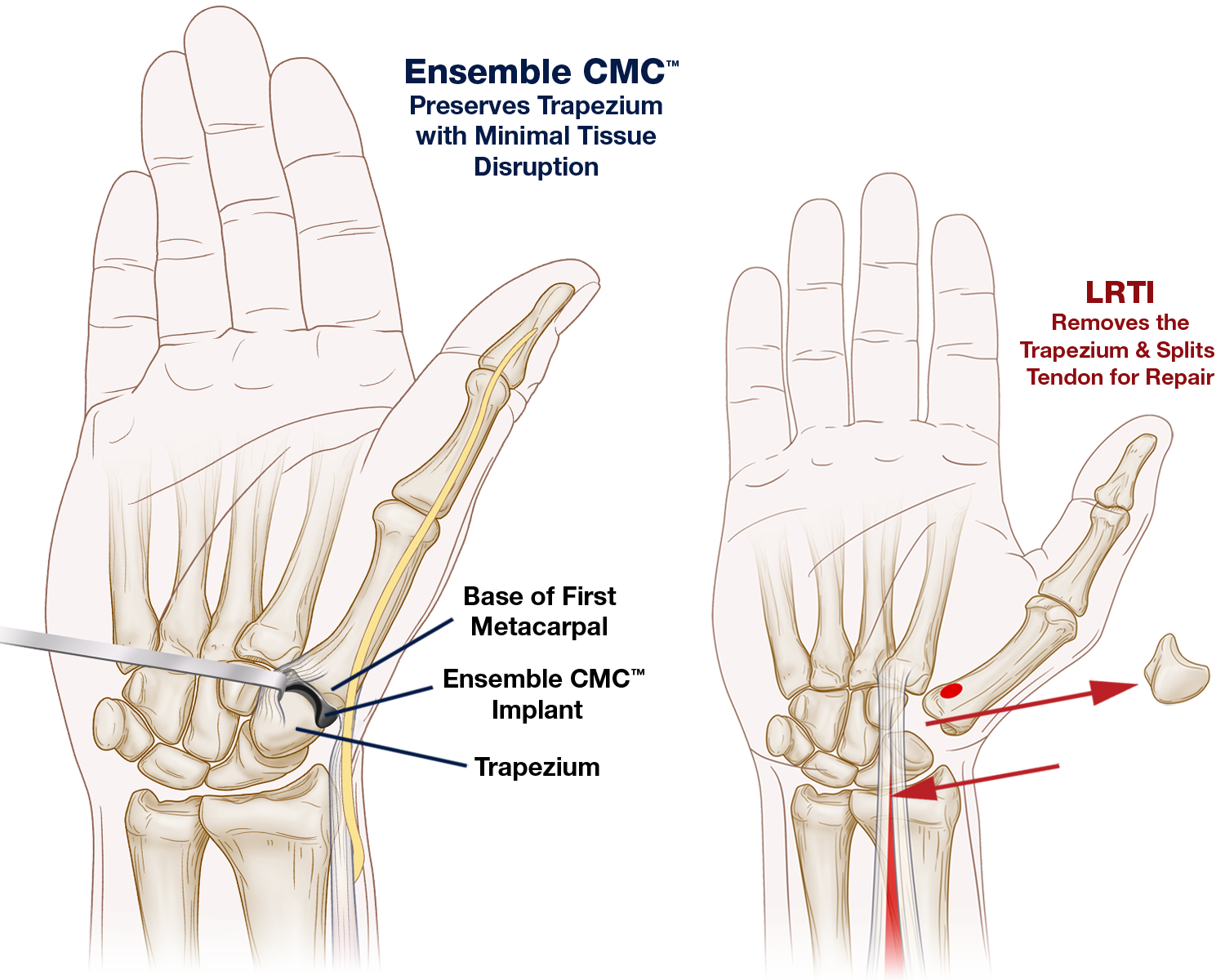 Ensemble CMC procedure comparison