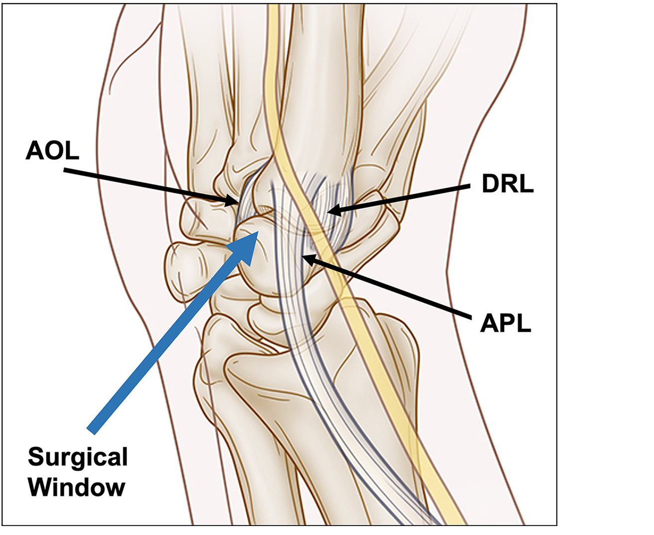 Surgical window of Ensemble CMC™ minimally invasive lateral approach